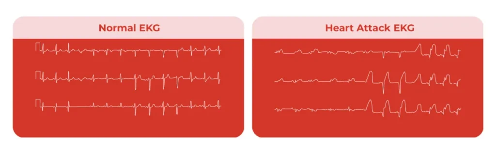 Can EKG Detect Heart Attack
