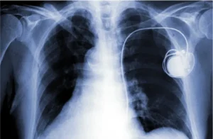 what-heart-conditions-require-pacemaker